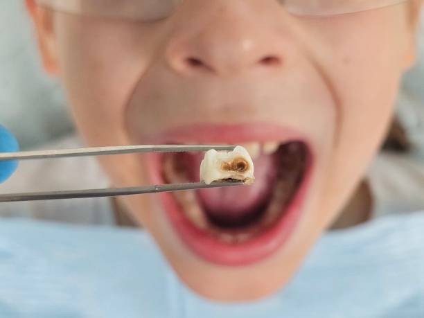 Best Knocked-Out Tooth (Avulsed Tooth) Treatment in Santa Maria, CA